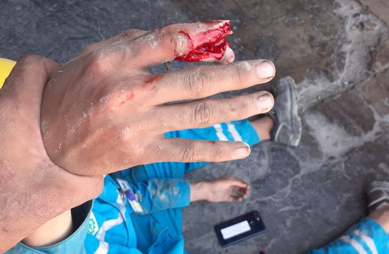 Foto: Nampak Jari telunjuk kanan Korban EZ Pasca Kecelakaan di pelabuhan PT. Conch North Sulawesi Cement 